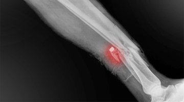 What is an Avulsion Fracture?