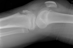 Avulsion Fracture Information