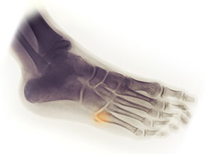 Foot Avulsion Fracture Treatment Information