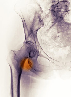 Hip Avulsion Fracture Information & Treatment